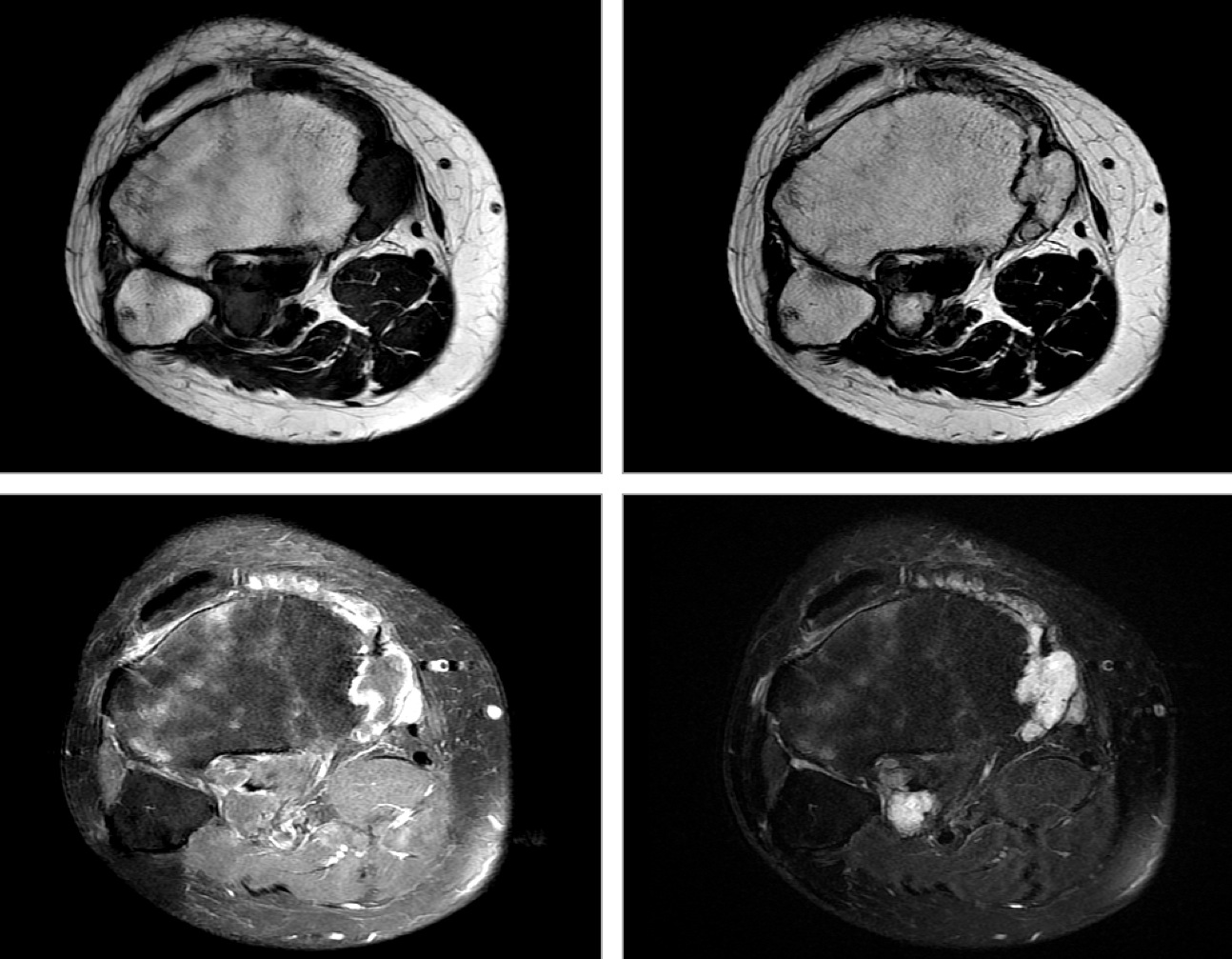 Figure 5 for case chronic synovitis